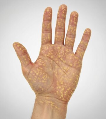 Understanding Nagashima-type palmoplantar keratoderma: genetics, symptoms, diagnosis, and management of this rare skin disorder.